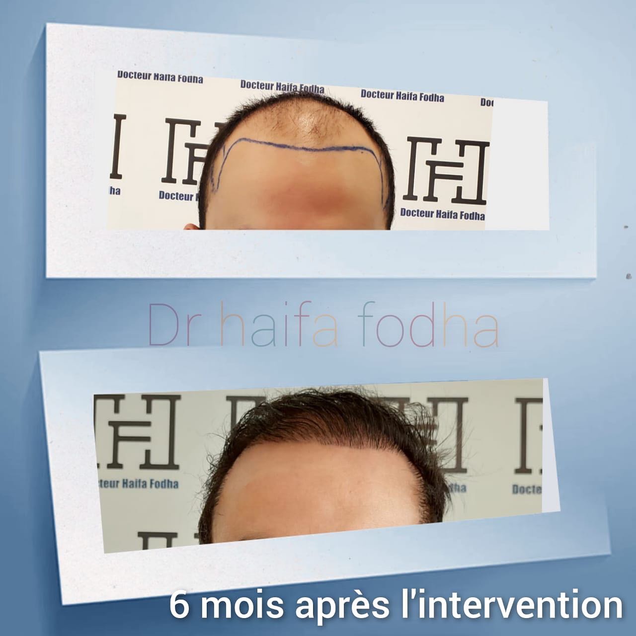 Un aperçu des résultats d'une greffe de cheveux à 6 mois post-intervention.